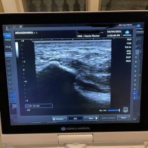Konica Minolta Sonimage HS1 Portable Ultrasound Machine