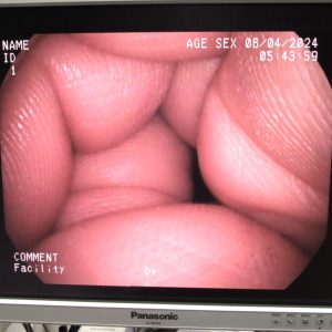 PENTAX VNL-1190STK Video Naso‑Pharyngo‑Laryngoscope