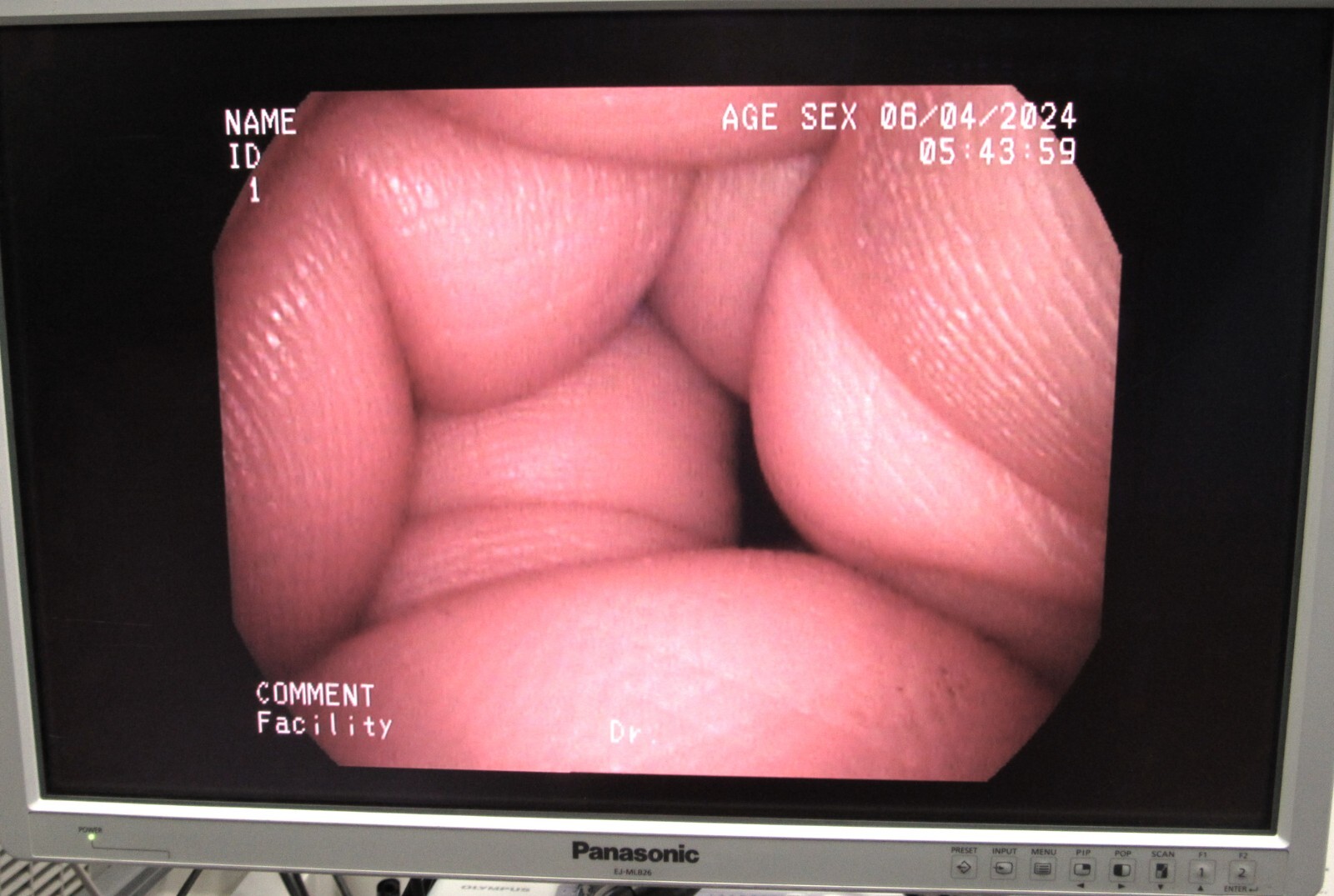 PENTAX VNL-1190STK Video Naso‑Pharyngo‑Laryngoscope